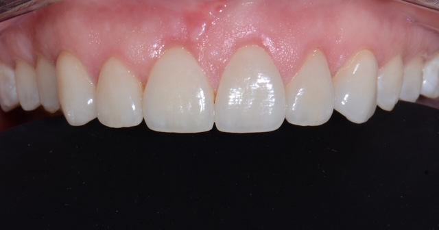 Aesthetic Restoration